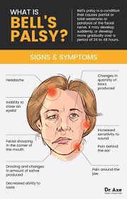 Bell's palsy is a condition that causes partial or complete weakness of one side of the face. Is Bell S Palsy From Lyme Disease Or Something Else Bells Palsy Facial Nerve Bell S Palsy Symptoms