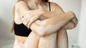 Lady having vitiligo on her full body