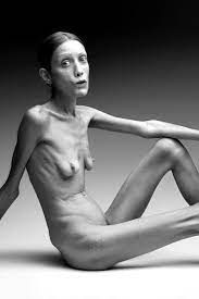 Anorexic Topless - 62 photos