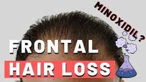 Minoxidil is scientifically proven to improve hair growth. Does Minoxidil Work On Frontal Hairline Baldness Hairguard