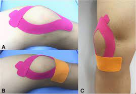 Effects Of Neuromuscular Training On Pain Intensity And Self Reported Functionality For Patellofemoral Pain Syndrome In Runners Study Protocol For A Randomized Controlled Clinical Trial Trials Full Text