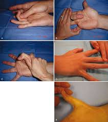 The integrity of fds and fdp tendons should be tested independently and in tandem. Hand Surgery Thoracic Key