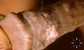 Image result for scabies norvegica