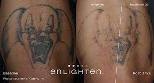 How many session will i need? Laser Tattoo Removal Dr Eugene Zappi Dr Laura Buccheri Zappi