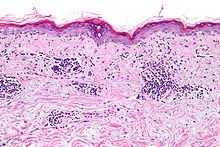 Lupus is a disease that occurs when your body's immune system attacks your own tissues and lupus can be difficult to diagnose because its signs and symptoms often mimic those of other ailments. Ø°Ø¦Ø¨Ø© Ø­Ù…Ø§Ù…ÙŠØ© Ø´Ø§Ù…Ù„Ø© ÙˆÙŠÙƒÙŠØ¨ÙŠØ¯ÙŠØ§