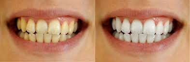 Unsere moderne praxis bietet die neuesten methoden des zahnbleaching. Bleaching Herne Zahnbleaching In Ihrer Zahnarztpraxis Wanne Eickel