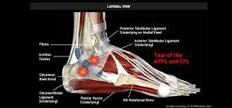 There are four ligaments in the knee that are prone to injury: Tear Of The Atfl And Cfl Thermoskin Supports And Braces For Injury And Pain Management