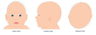 Image result for Positional Head Deformity