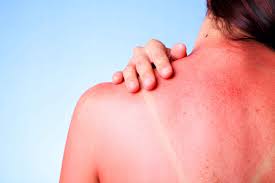 Crema Para Quemaduras Del Sol Cual Escoger Skinexpert