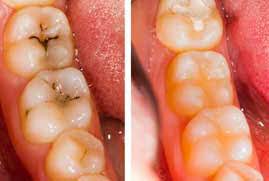 Dental Filling And Tooth Cavity Filling Cost Treatment Causes