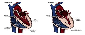 Image result for Cardiomyopathy