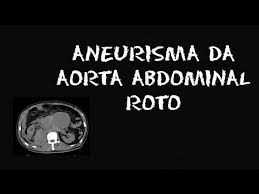 Ecg chanegs of left ventricular aneurysm (persistent st elevation following stemi) with some ecg examples. Aneurisma Da Aorta Abdominal Roto Youtube
