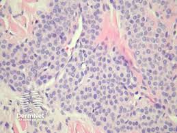 Image result for Glomus tumor