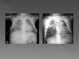 Pneumonia is a bacterial, viral, or fungal infection of the lungs that causes the air sacs, or alveoli, of the lungs to fill up with fluid or pus. Caso Clnico Pneumonia Neonatal Apresentao Marlia Monteiro Coordenao