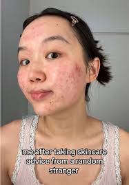 Ginny Hyperpigmentation