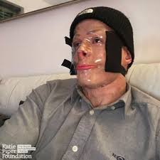 Burns survivor Darren will be taking the leap of a lifetime by skydiving to  raise funds for The Katie Piper Foundation