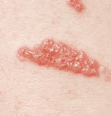 Image result for Rhus Dermatitis