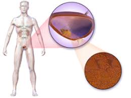 The main symptom of bladder cancer is blood in your urine. Bladder Cancer Wikipedia