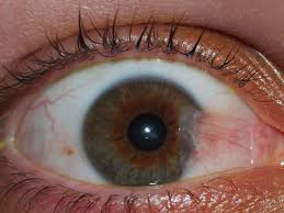 Pterygium Surgery Glue