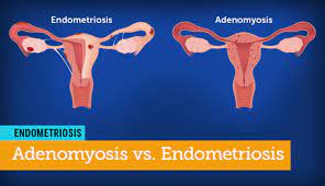 Both endometriosis and adenomyosis affect women. Adenomyosis Vs Endometriosis Are They One And The Same Myendometriosisteam