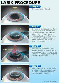 Toplasik Procedure Fort Worth Eye Surgery Lasik Eye Surgery Laser Eye Surgery