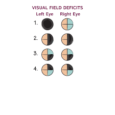 Image result for Visual Field Deficit