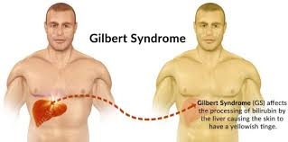 Crampe la stomac și balonare. Semne Ale Unui Ficat Bolnav AflÄƒ Ce IÈ›i AratÄƒ Corpul Aktualnews Ro