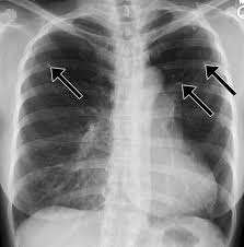 Case contributed by dr brenda lee solorzano frontal chest x ray shows bilateral micronodular insterstitial effusion. Pulmonary Tuberculosis Role Of Radiology In Diagnosis And Management Radiographics
