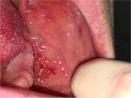 Bumps may begin appearing inside the mouth mainly because of food irritation. Rash Inside The Mouth Photo Quiz American Family Physician