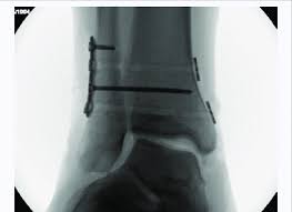 Image result for Talar Tilt