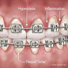 Carefully clean around wires and pins. Be On The Alert For Gum Disease While Wearing Braces Image Dental