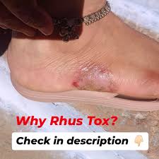 Image result for Rhus Dermatitis