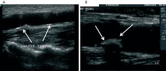 Echocardiography Of Chd In Adults | Ppt