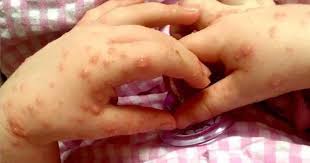 Punca utamanya ialah persekitaran yang kotor. Penyakit Tangan Kaki Dan Mulut Klinik Dr Tiwi