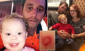 Suffolk dad falsely accused of child abuse after rash