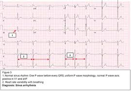 Maybe you would like to learn more about one of these? Ekg Interpretation