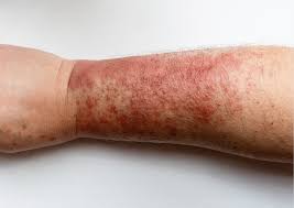 Image result for Atopic Dermatitis
