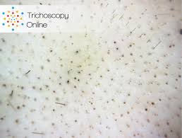 Image result for Anthralin