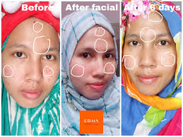 Jika anda tidak ingin jerawat muncul di pipi, hindari penyebab jerawat di pipi berikut Tuty Saca Signature Dpct Facial Erha Facial Tanpa Sakit Dan Aman Untuk Kulit Sensitive