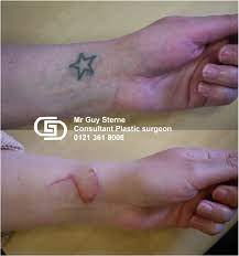 Surgical excision of tattoos can be carried out. Tattoo Removal