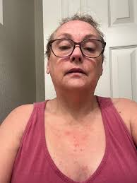 I got the pneumococcal vaccine last Tuesday. After that the symptoms got  worse, e.g. blood sugar rose to 19.6 and this morning the urine was  orange-red. Tearing, throbbing and stiffening pain is