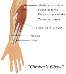 The combination of firm palpation over the medial epicondyle and resisted flexion will likely elicit a familiar pain experienced by the patient over the medial epicondyle. Treating Climber S Elbow Training For Climbing By Eric Horst
