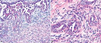 1, a) the histology was superficially similar to that of a. Malignant And Borderline Mesothelial Tumors Of The Pleura Sciencedirect