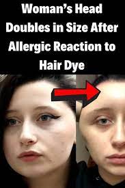 Woman S Head Doubles In Size After Allergic Reaction To Hair Dye Nursing Memes Funny Nurse Quotes Breastfeeding Humor