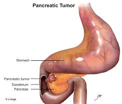 The tumor is growing outside of the pancreas and has moved into nearby large blood vessels or major nerves. Pancreatic Cancer Oncology Medbullets Step 2 3