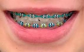Green Teal Green Braces Dental Braces Braces Colors