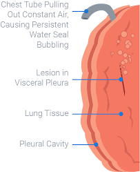 Blowing Bubbles With Chest Drains Medbridge Blog