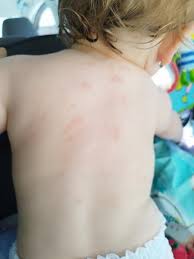 Image result for vyrážka u dětí