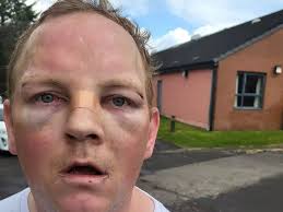 Dad slams Glasgow NHS after son beaten black and blue with pool cue in  hospital