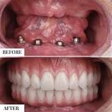 What's the ideal cost Of Dental Implants In India – Stunning ...
